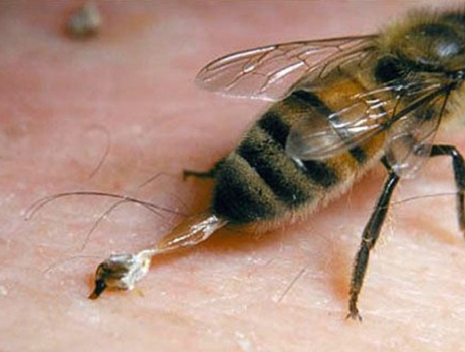 сыворотка от пчелиного яда, африканизированные пчелы, ужаление пчелами